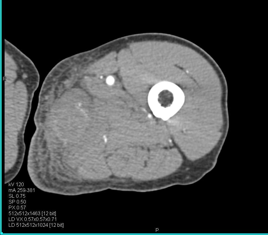 Hematoma Left Thigh - CTisus CT Scan