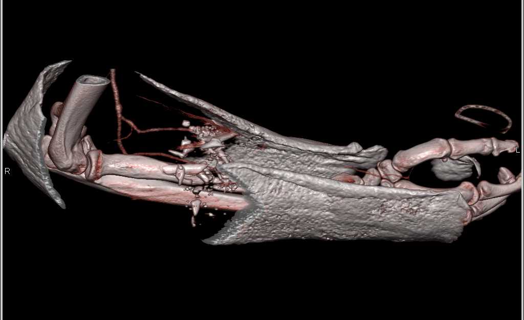 Gunshot Wound (GSW) with Comminuted Radial Fracture - CTisus CT Scan
