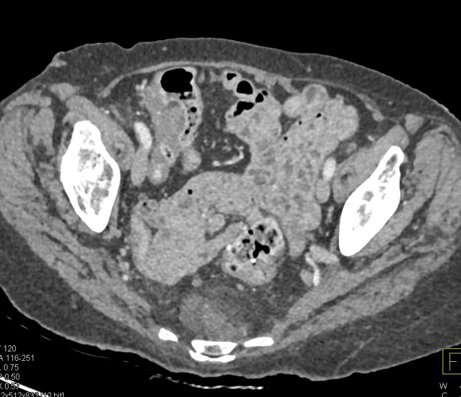 Myelolipoma in Presacral Space - CTisus CT Scan