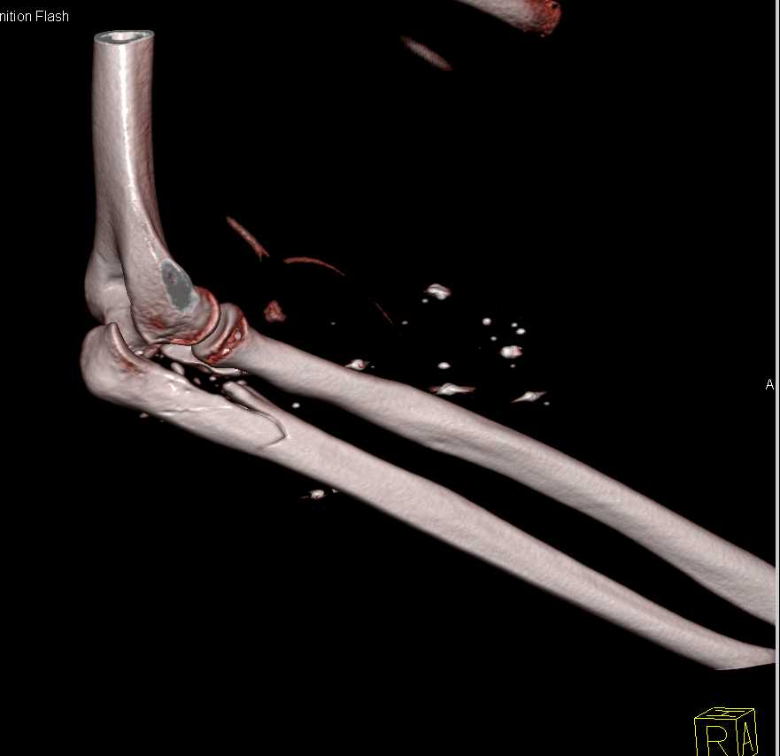 Gunshot Wound (GSW) with Ulnar Fracture - CTisus CT Scan