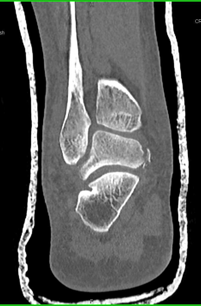 Fractures of the Talus - CTisus CT Scan