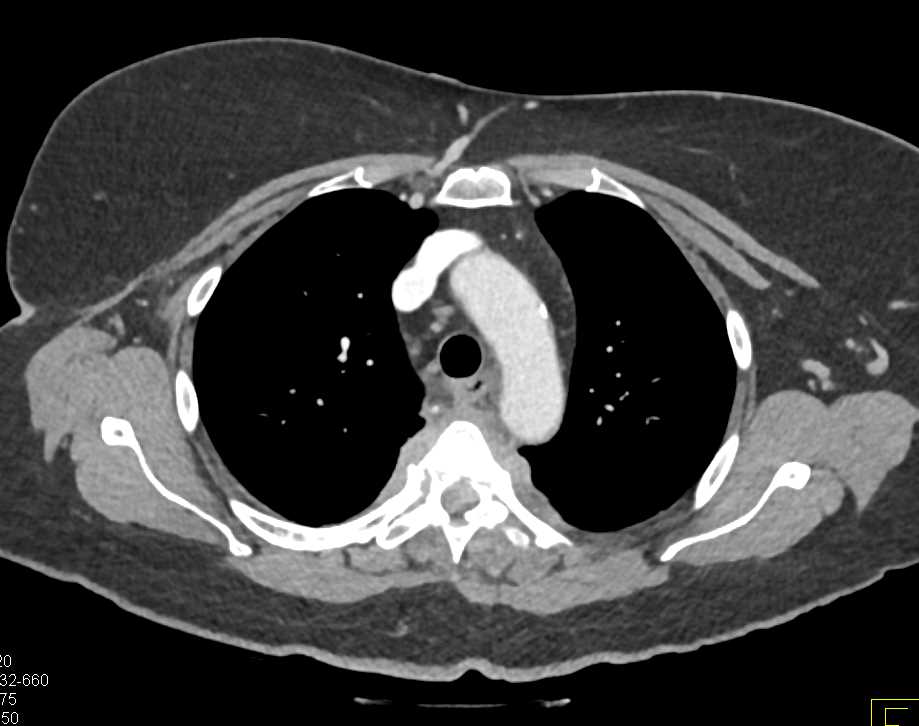 Osteomyelitis T-Spine - CTisus CT Scan