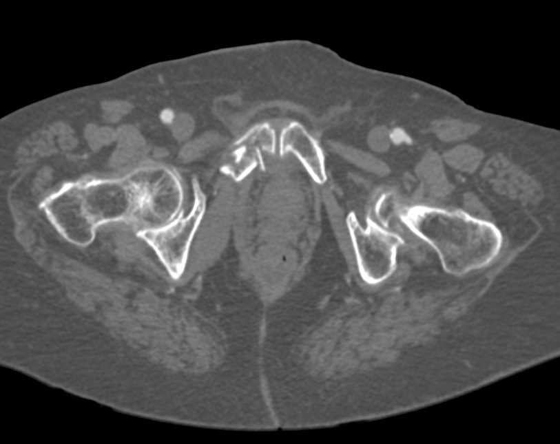Superior Pubic Ramus Fracture - CTisus CT Scan