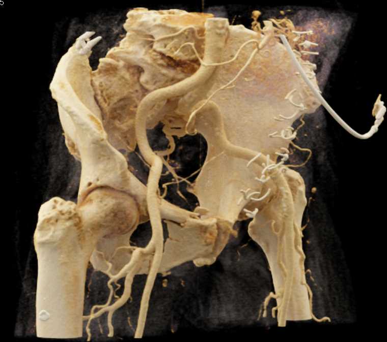 Superior and Inferior Pubic Ramus Fracture with Cinematic Rendering - CTisus CT Scan