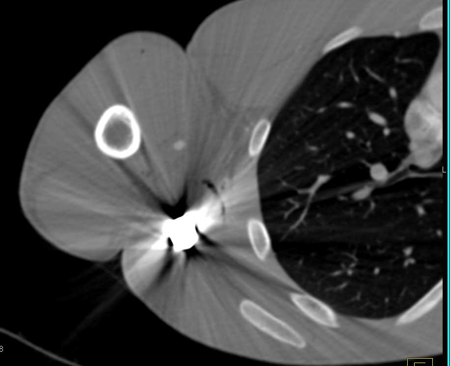 Gunshot Wound (GSW) Shoulder Without Vascular Injury - CTisus CT Scan