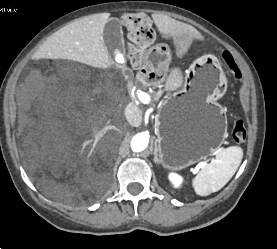 Liposarcoma Involves the Right Kidney - CTisus CT Scan