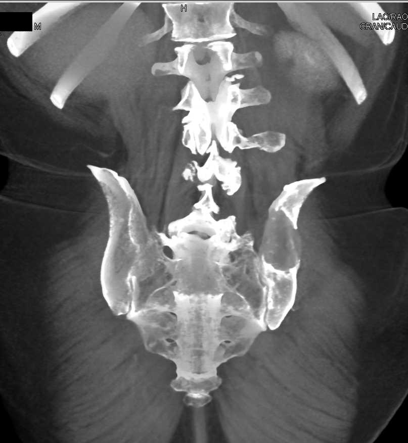 Myeloma Left Iliac Bone - CTisus CT Scan