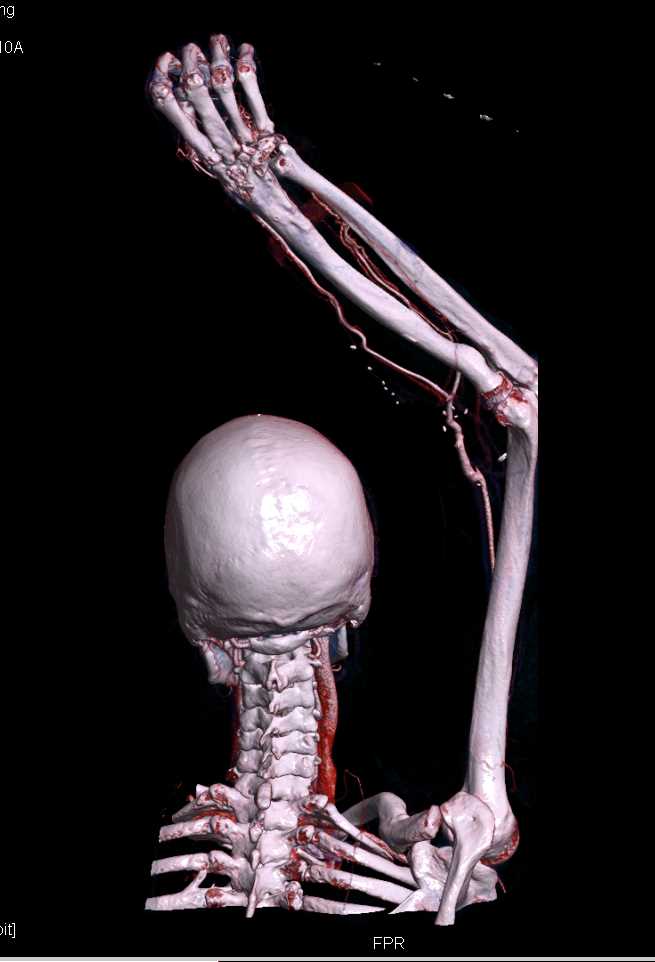 CTA of the Upper Extremity with Cinematic Rendering - CTisus CT Scan