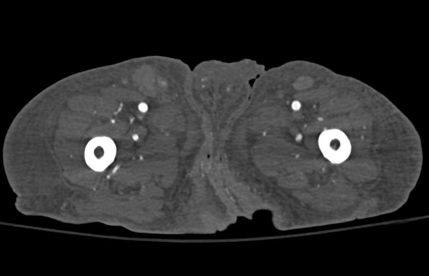 Below Knee Amputation of the Leg - CTisus CT Scan