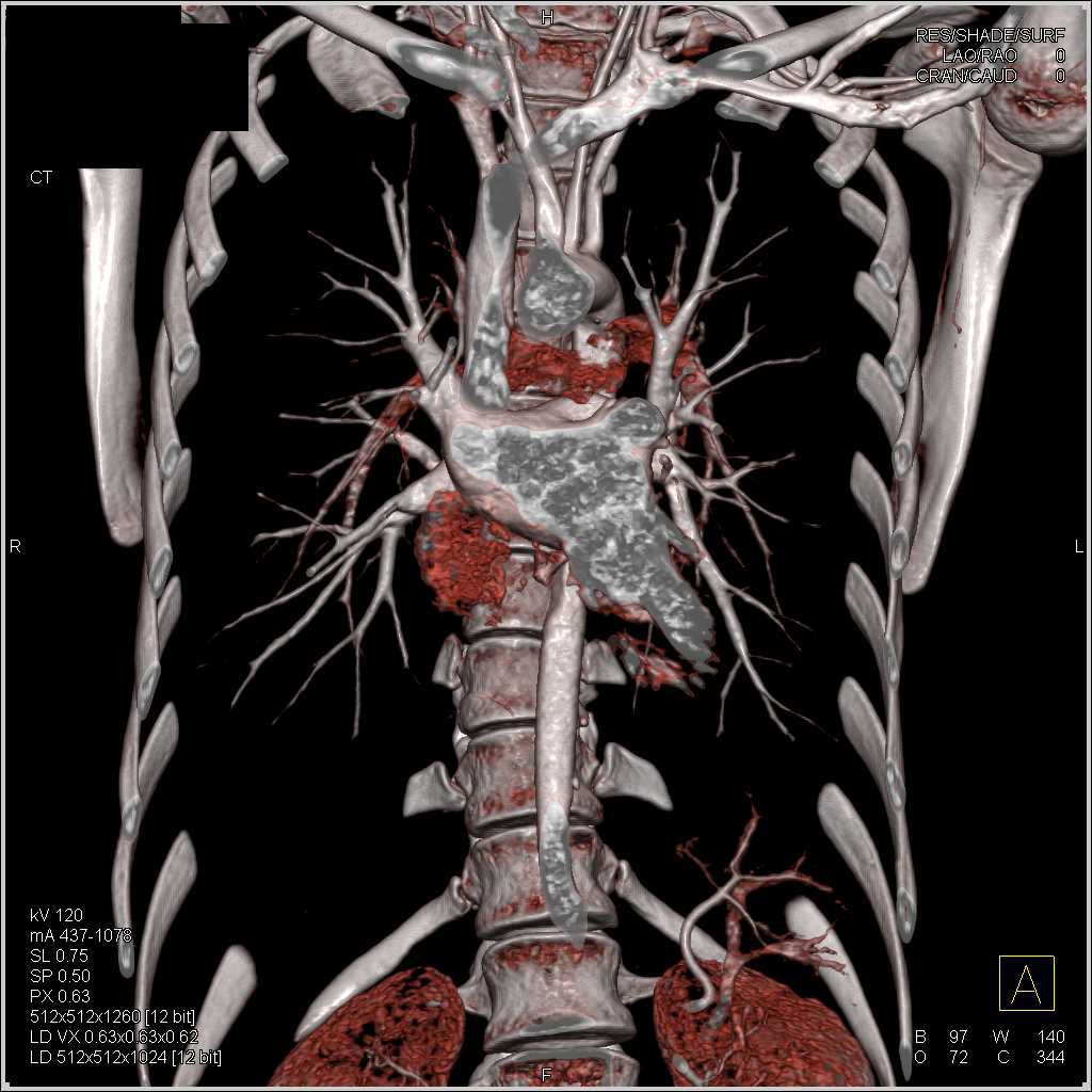 Anatomy with VRT and Cinematic Rendering - CTisus CT Scan