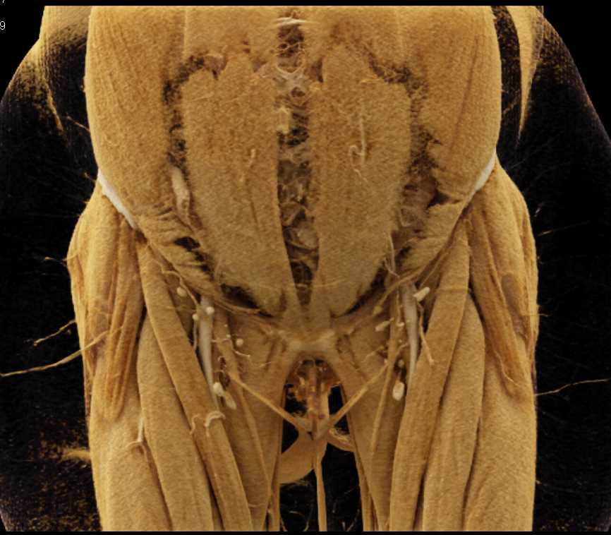 Diastasis of the Rectus Muscle with Cinematic Rendering - CTisus CT Scan
