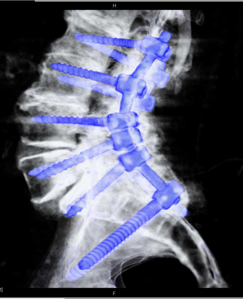 Hardware in the L-Spine - CTisus CT Scan