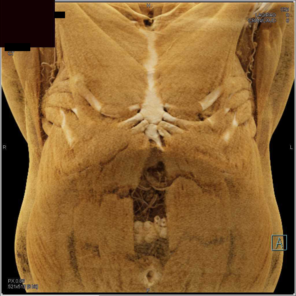 Dehiscence of the Rectus Muscles in the Midline with Cinematic Rendering - CTisus CT Scan