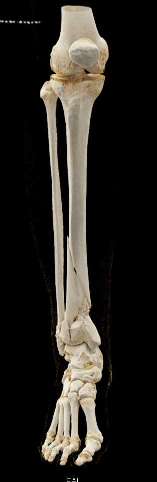 Spiral Fractures of the Tibia and Fibula with Cinematic Rendering - CTisus CT Scan