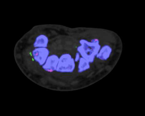 Gout - CTisus CT Scan
