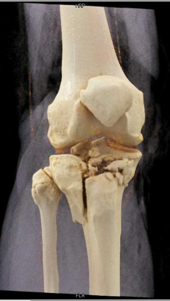 Tibial Plateau and Fibular Fractures - CTisus CT Scan