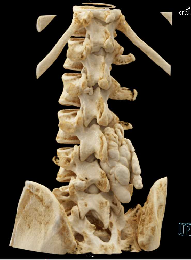 Tumoral Calcinosis by the L-Spine with Cinematic Rendering - CTisus CT Scan