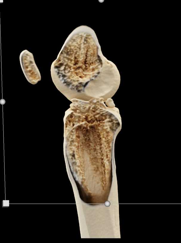 Tibial Plateau Fracture with Cinematic Rendering - CTisus CT Scan