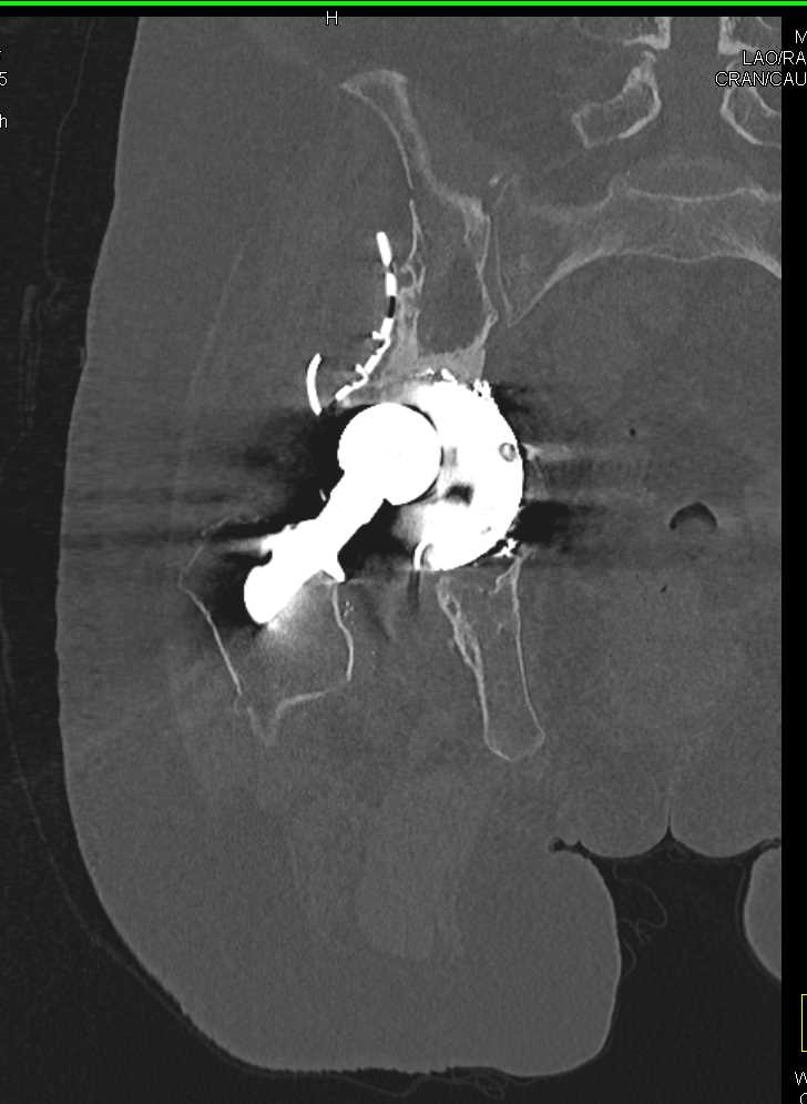 Failed Right Total Hip Replacement (THR) - CTisus CT Scan