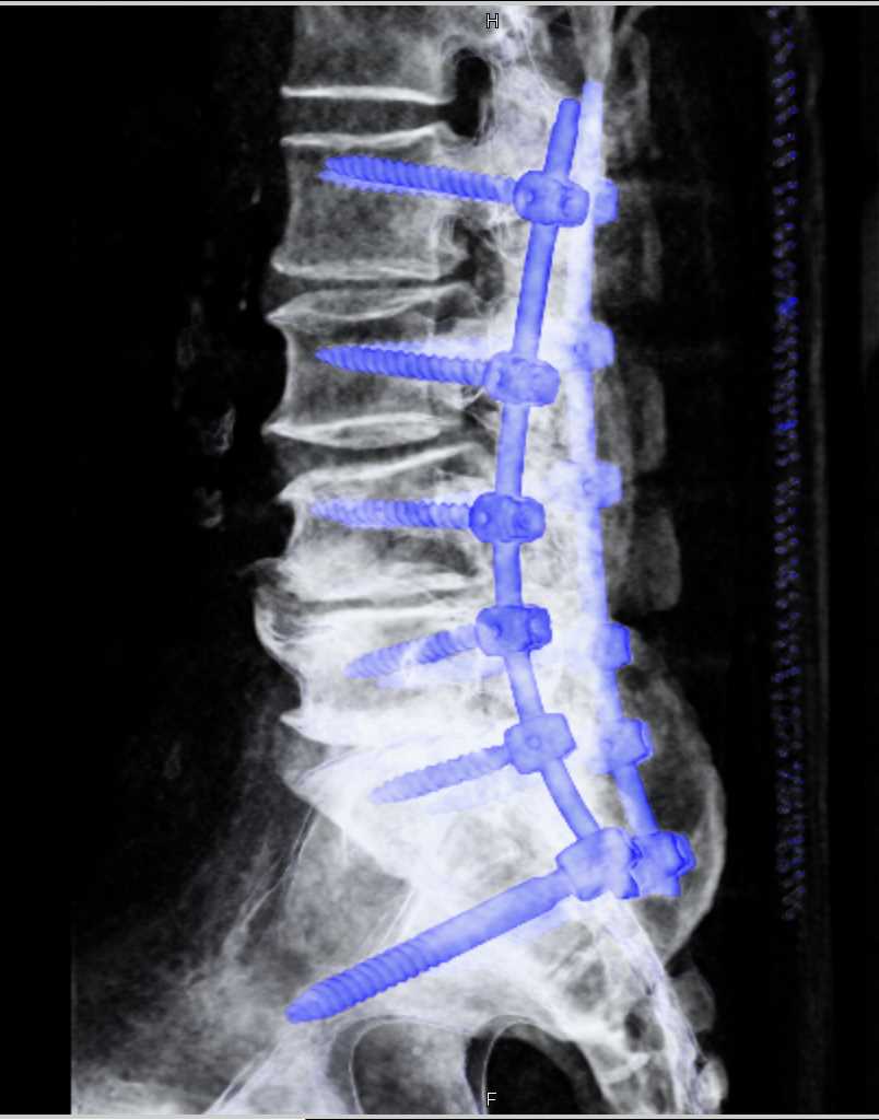Hardware in Spine with Roconstruction - CTisus CT Scan