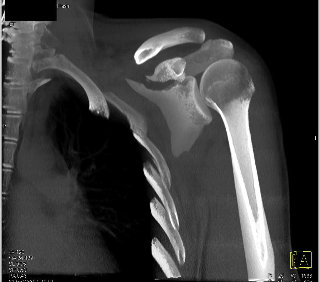 Scapular Fracture - CTisus CT Scan