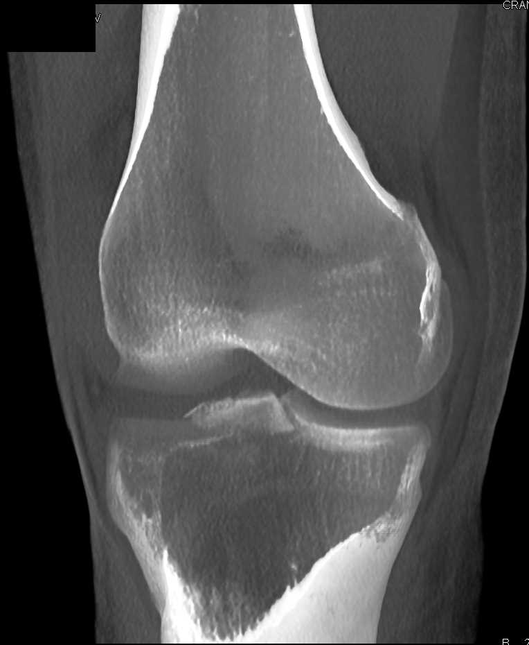 Tibial Plateau Fracture - CTisus CT Scan