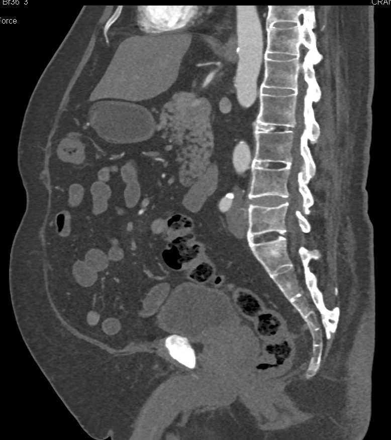Calcified Disc Disease - CTisus CT Scan