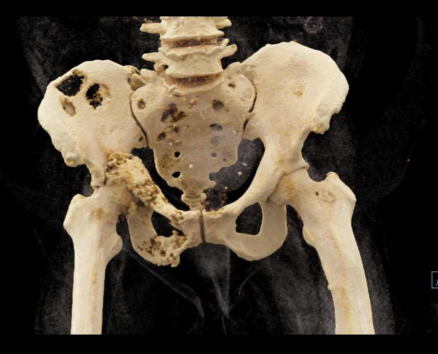 Multiple Myeloma - CTisus CT Scan