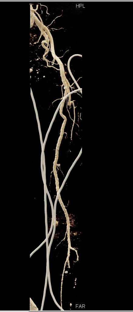 Femur Fracture - CTisus CT Scan