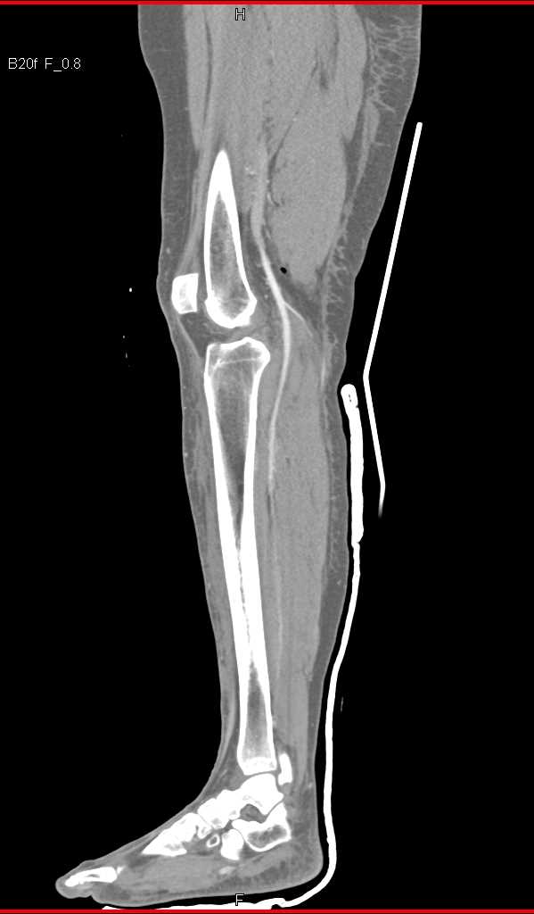 Trauma to Leg Without Vascular Injury - CTisus CT Scan