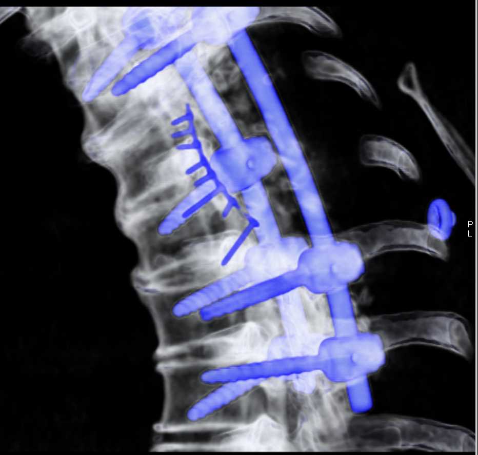 C-Spine Repair with Hardware - CTisus CT Scan