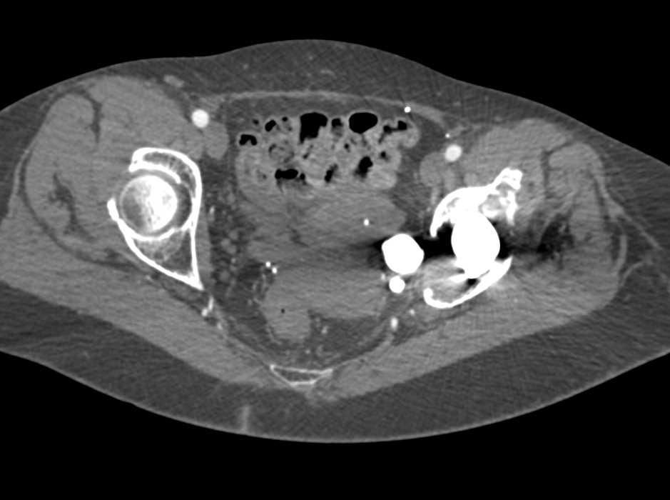 Failed Left Hip Transplant - CTisus CT Scan