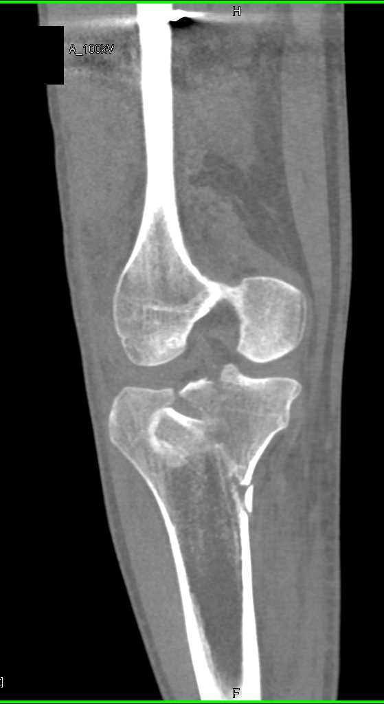 Tibial Plateau Fracture - CTisus CT Scan