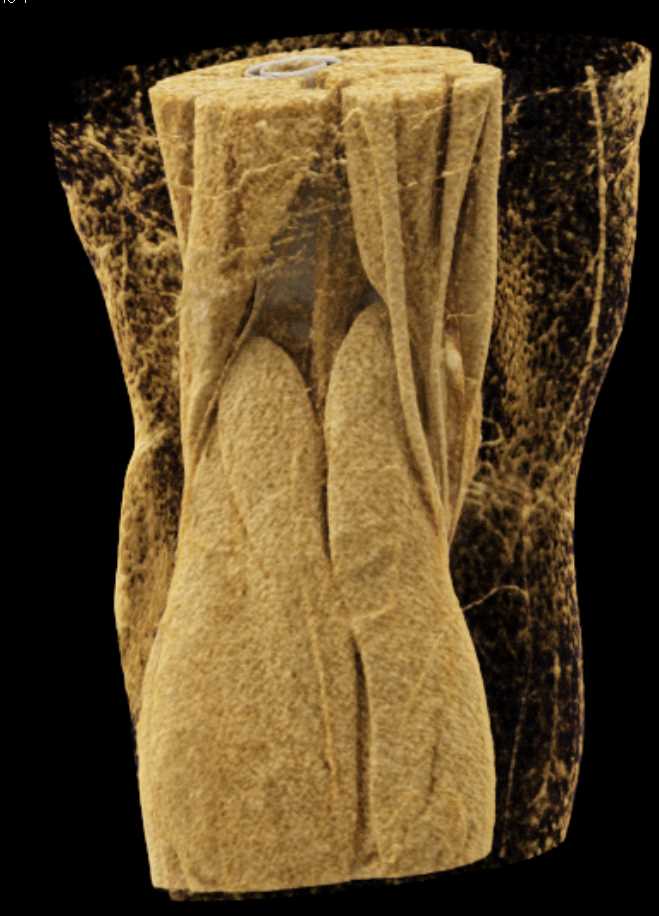 Tibial Plateau Fracture - CTisus CT Scan