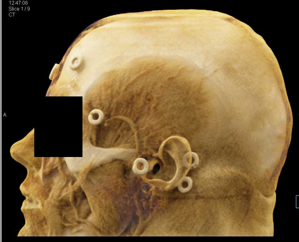 Osteoma Skull - CTisus CT Scan