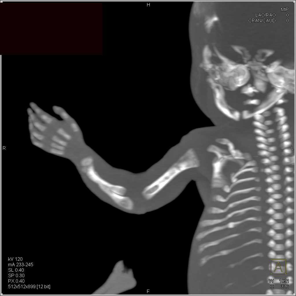 Osteogenesis Imperfecta - CTisus CT Scan