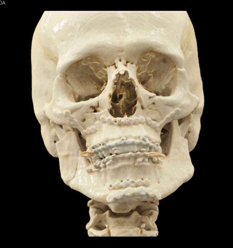 Repair of Orbital Fractures - CTisus CT Scan