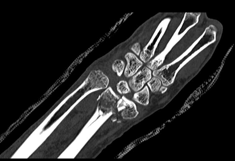 Distal Radius Fracture - CTisus CT Scan