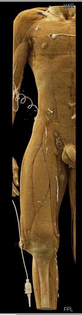 Fracture Distal Femur Without Vascular Injury - CTisus CT Scan