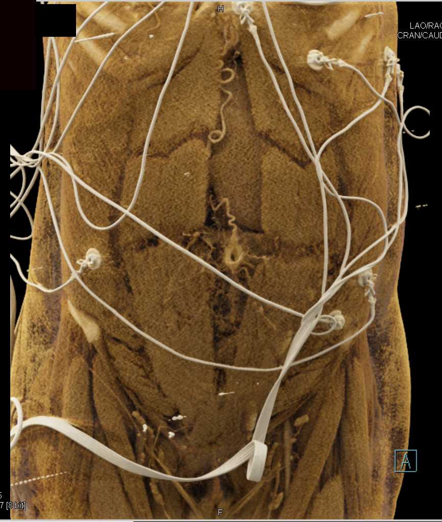 Abdominal Wall Plus - CTisus CT Scan