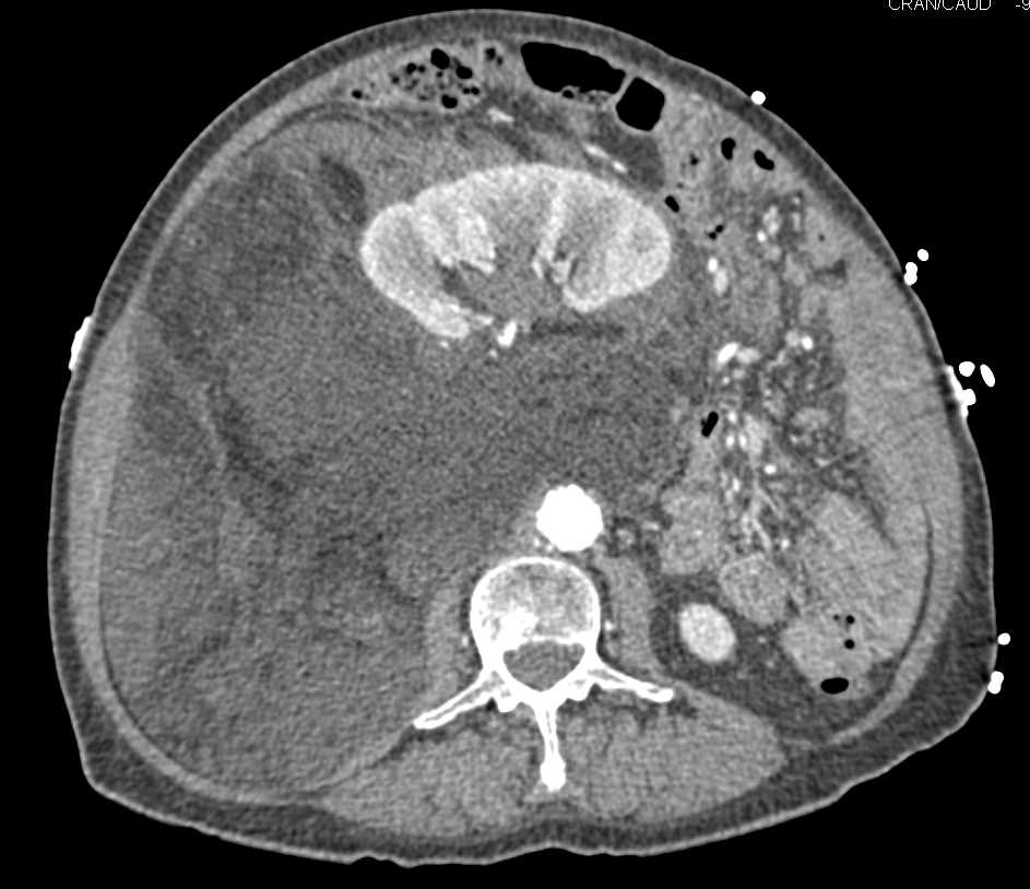 Retroperitoneal Liposarcoma - CTisus CT Scan