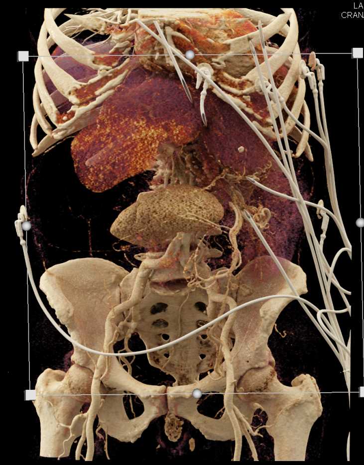 Retroperitoneal Liposarcoma - CTisus CT Scan