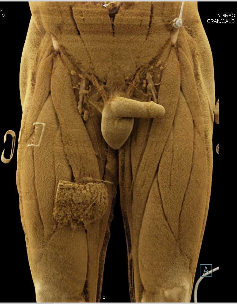 Gunshot Wound (GSW) Thigh with Superficial Femoral Artery (SFA) Injury and Active Bleed with Cinematic Rendering - CTisus CT Scan