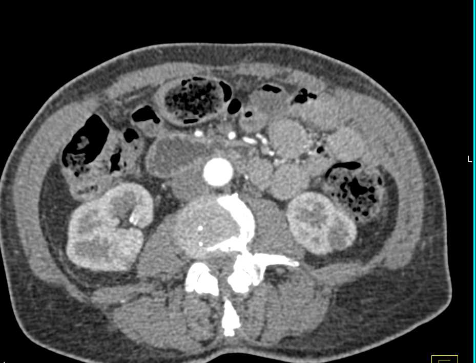 Widespread Blastic Bone Metastases - CTisus CT Scan