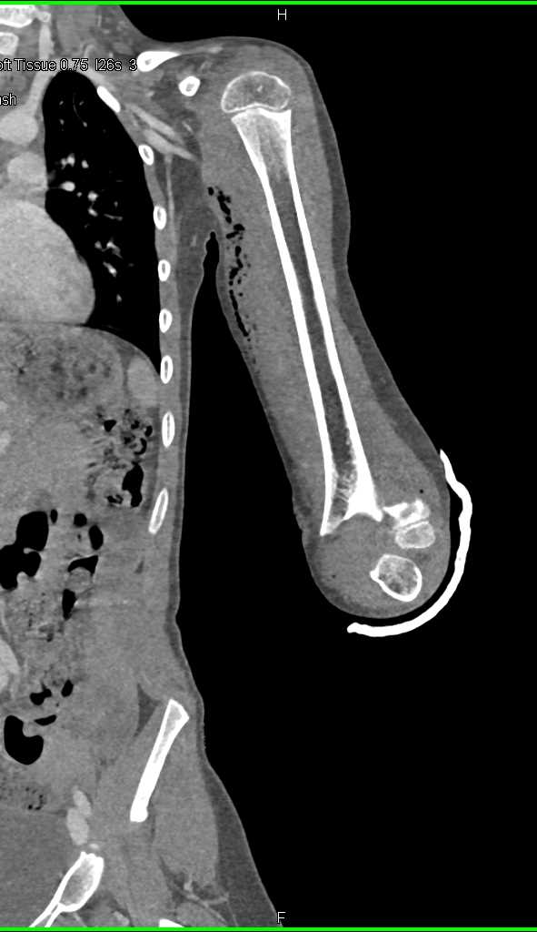 Fracture thru Epiphysis with Displacement - CTisus CT Scan