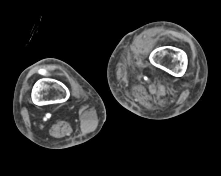 Bleed Left Thigh with Graft - CTisus CT Scan