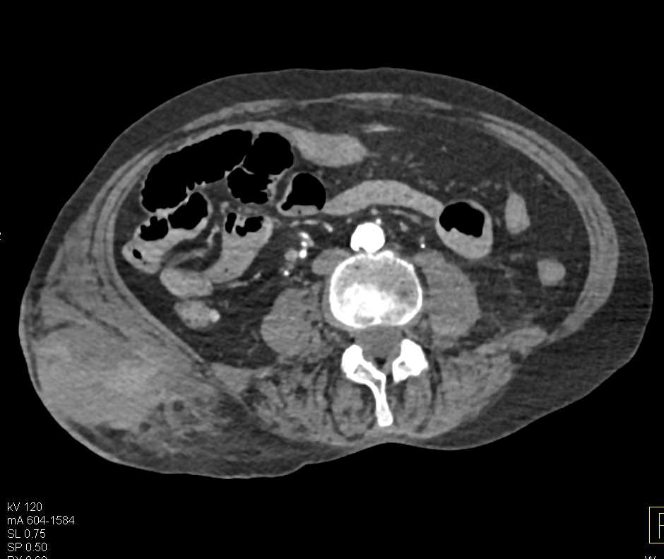 Active Bleed Right Flank Hematoma s/p Motor Vehicle Accident (MVA) - CTisus CT Scan