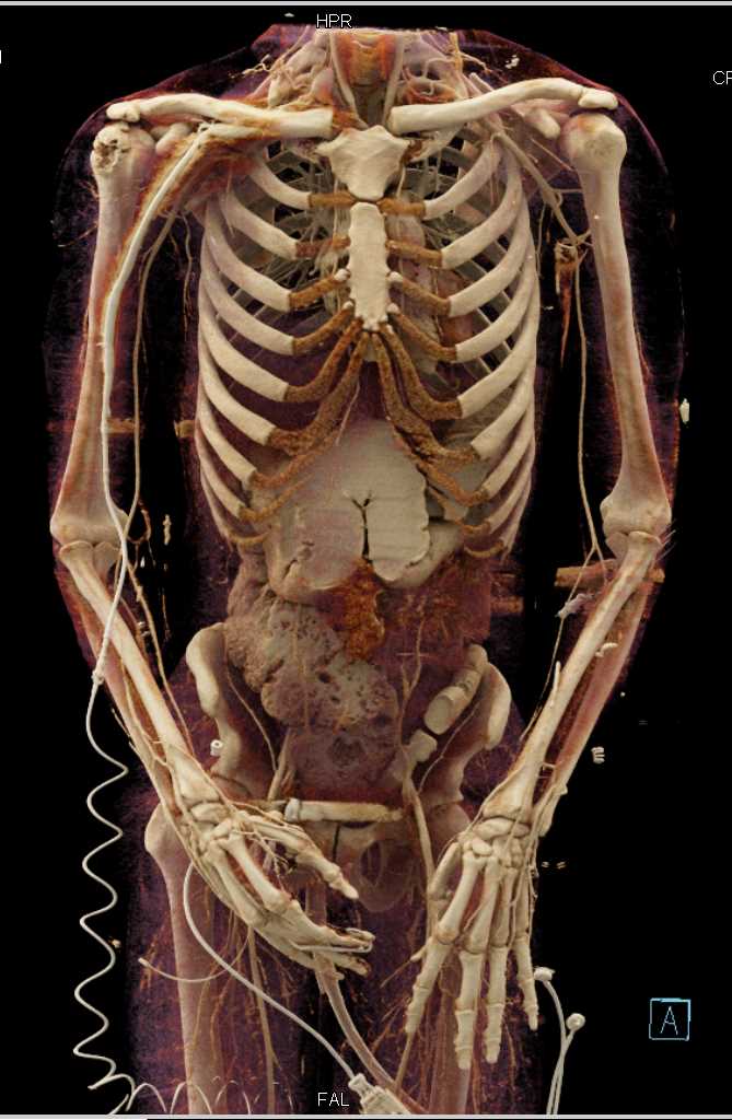 Trauma with L-Spine Fracture - CTisus CT Scan