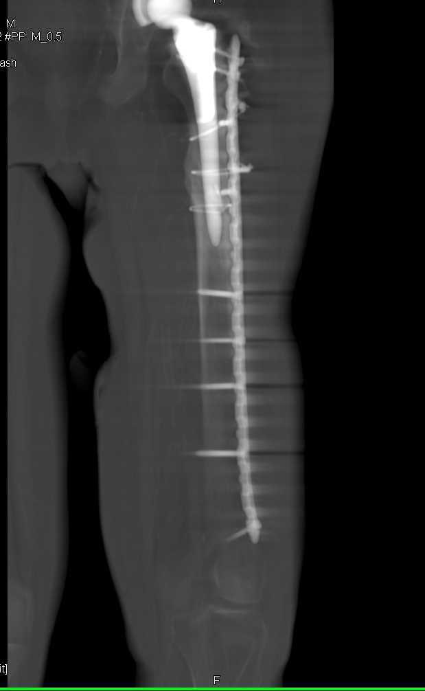 Total Hip Replacement (THR) and Hardware Left Femur - CTisus CT Scan