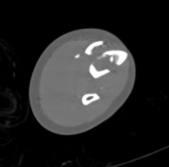 Spiral Tibial Fracture Without Vascular Injury - CTisus CT Scan